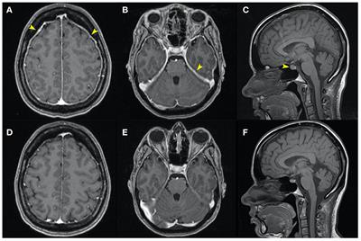 Thunderclap headache revealing dural tears with symptomatic intracranial hypotension: Report of two cases